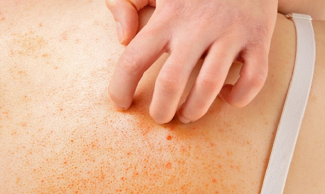 Dark Circles & Stretch Marks