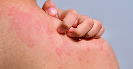 Dark Circles & Stretch Marks