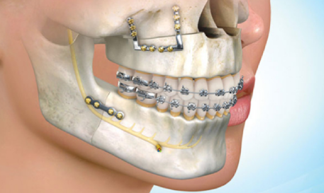 Maxillofacial Surgery